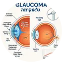 גלאוקומה